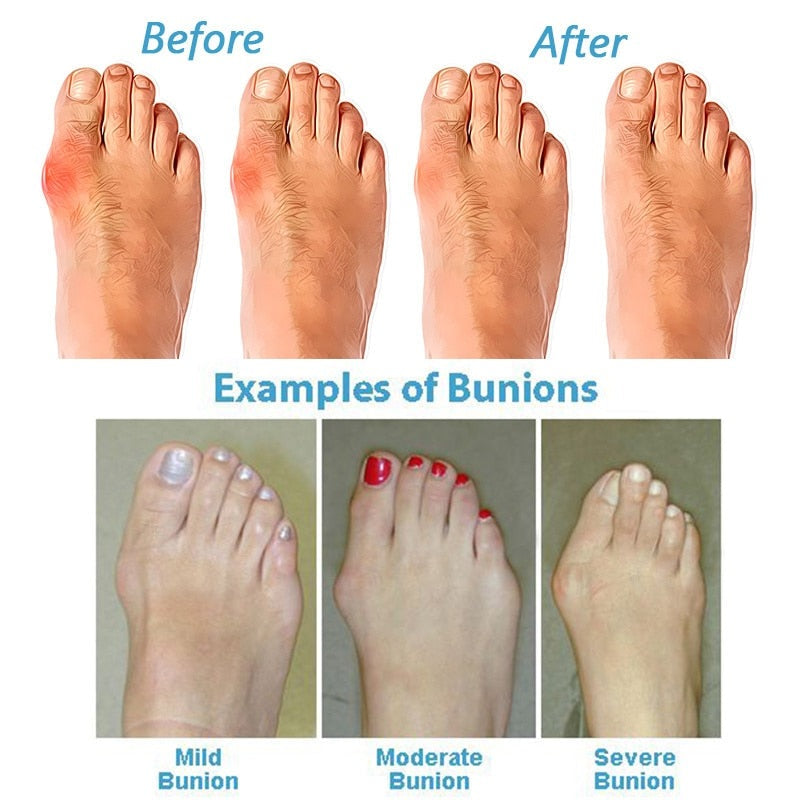 Orlando Orthopedic Bunion Corrector Sandals